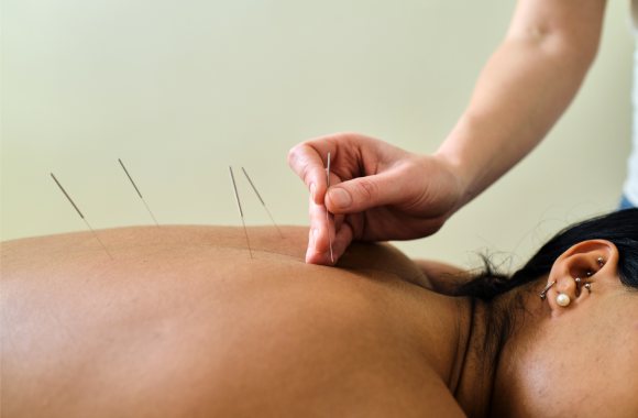 Akupunkturnadeln im Rücken einer Person