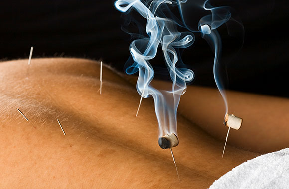 Akupunktur und Moxibustion - zwei starke Partner