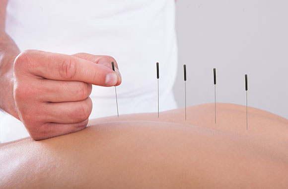 Akupunkturbehandlung Akupunktur bei Bandscheibenvorfall