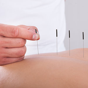 Akupunktur bei Bandscheibenvorfall