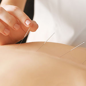 Akupunktur bei chronischen Rückenschmerzen