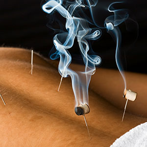 Akupunktur mit Moxibustion