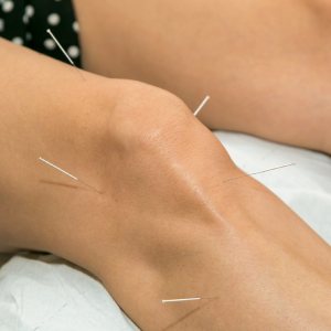 Akupunktur bei Arthrose